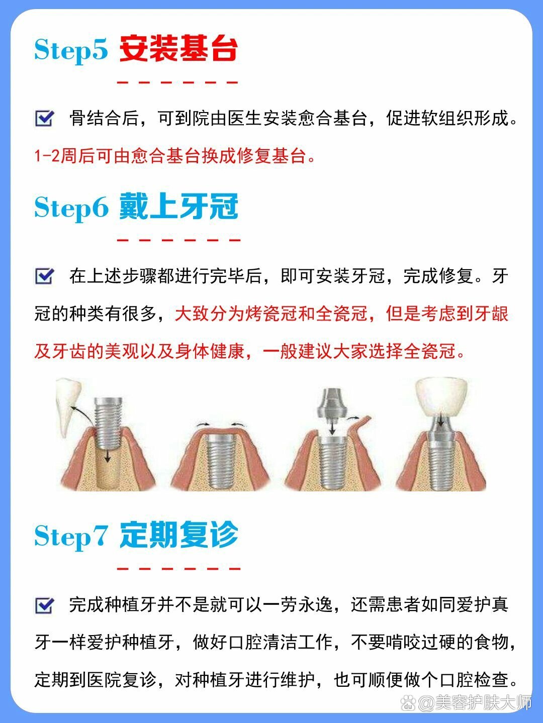 7个步骤了解种植牙种植全过程