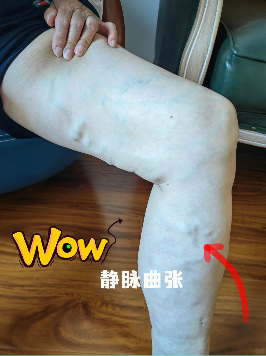 静脉曲张怎么办?10种运动方式来解围?