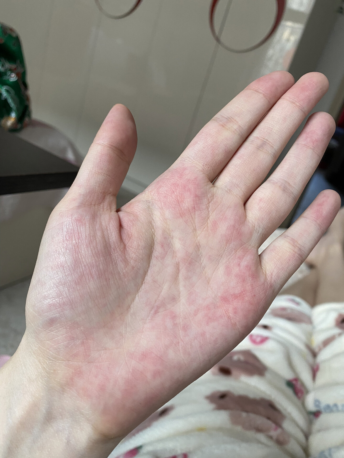 大家怀孕有手掌变这样的吗