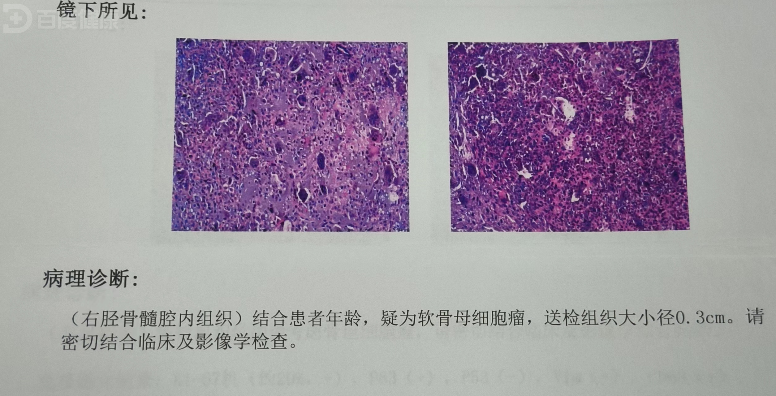 软骨母细胞瘤的手术治疗