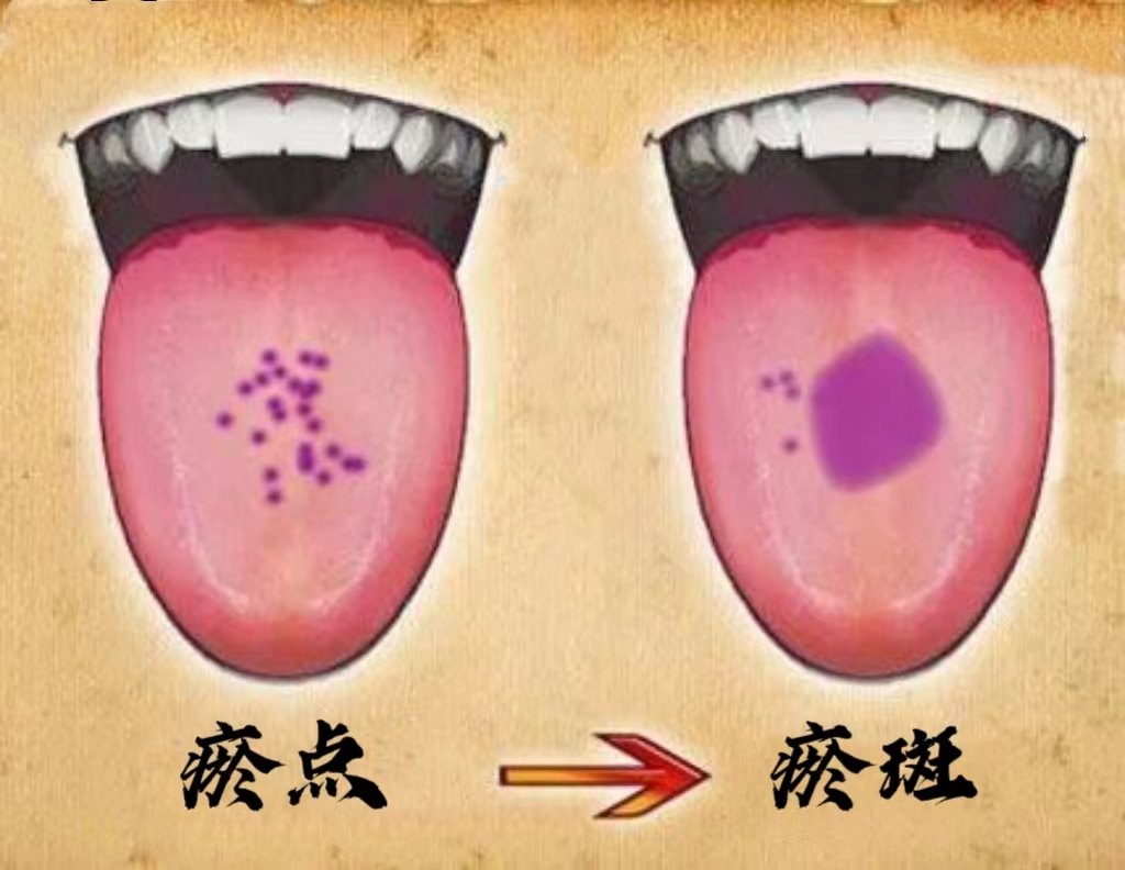 体内有瘀血的8大特征，你中了几条？