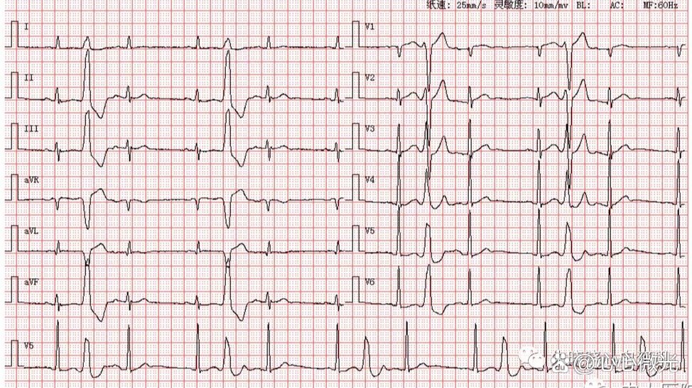 室性早搏三联律心电图图片