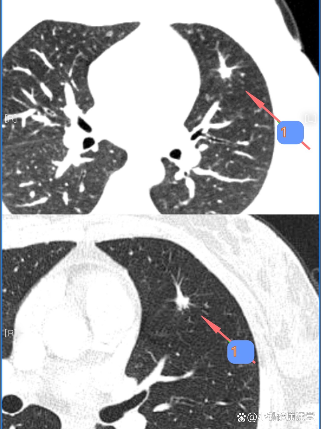 不规则实性毛刺征8mm肺结节
