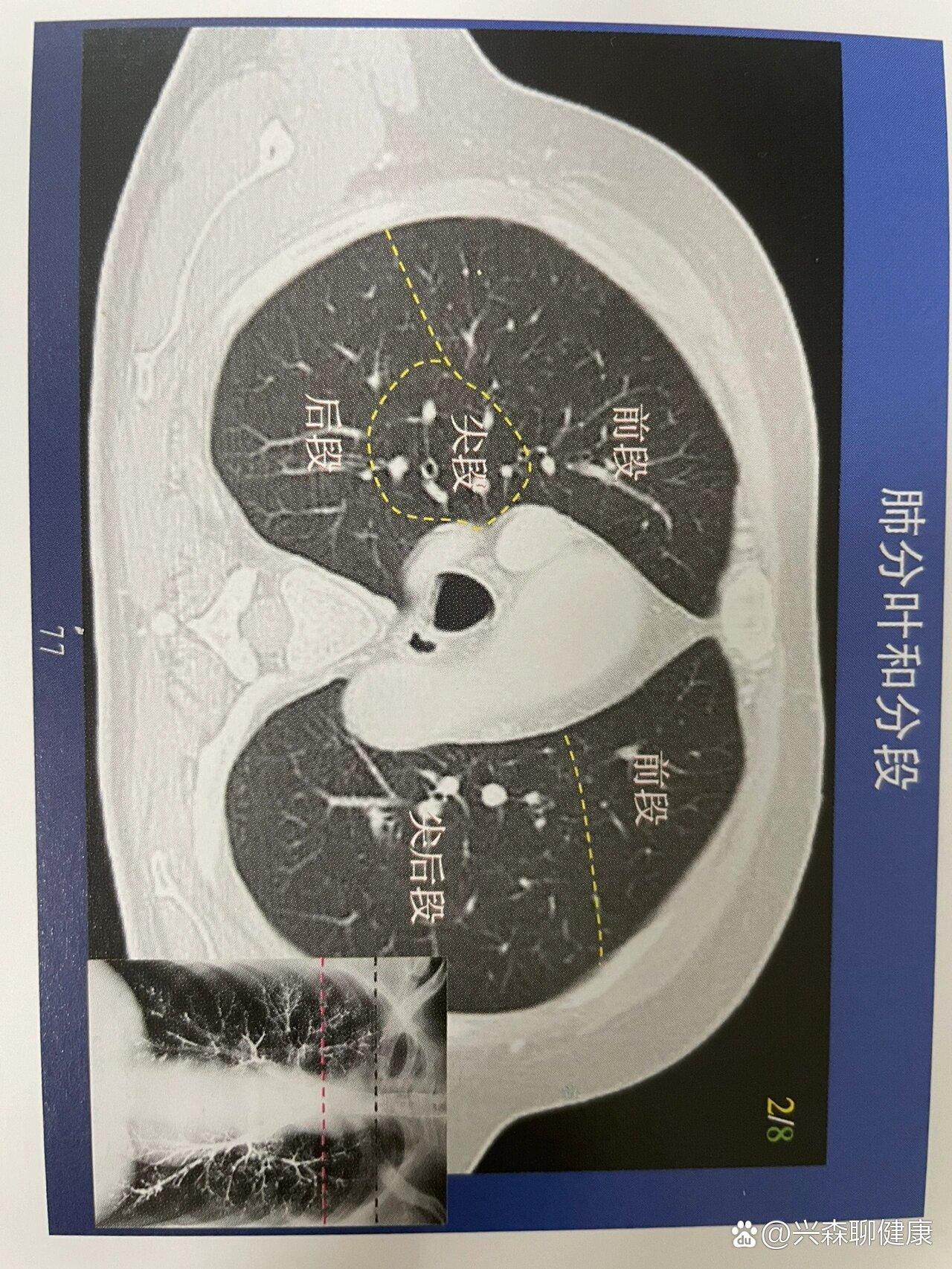 肺段划分ct图片