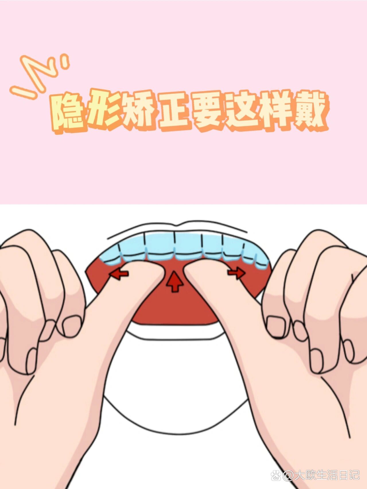隐形矫正器要这样摘戴