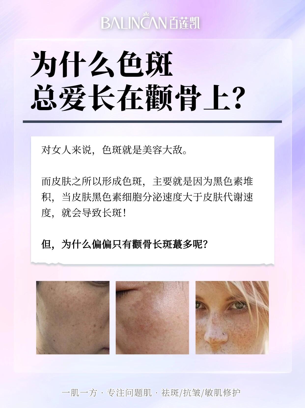 悟了6015原来这才是颧骨长斑的真相