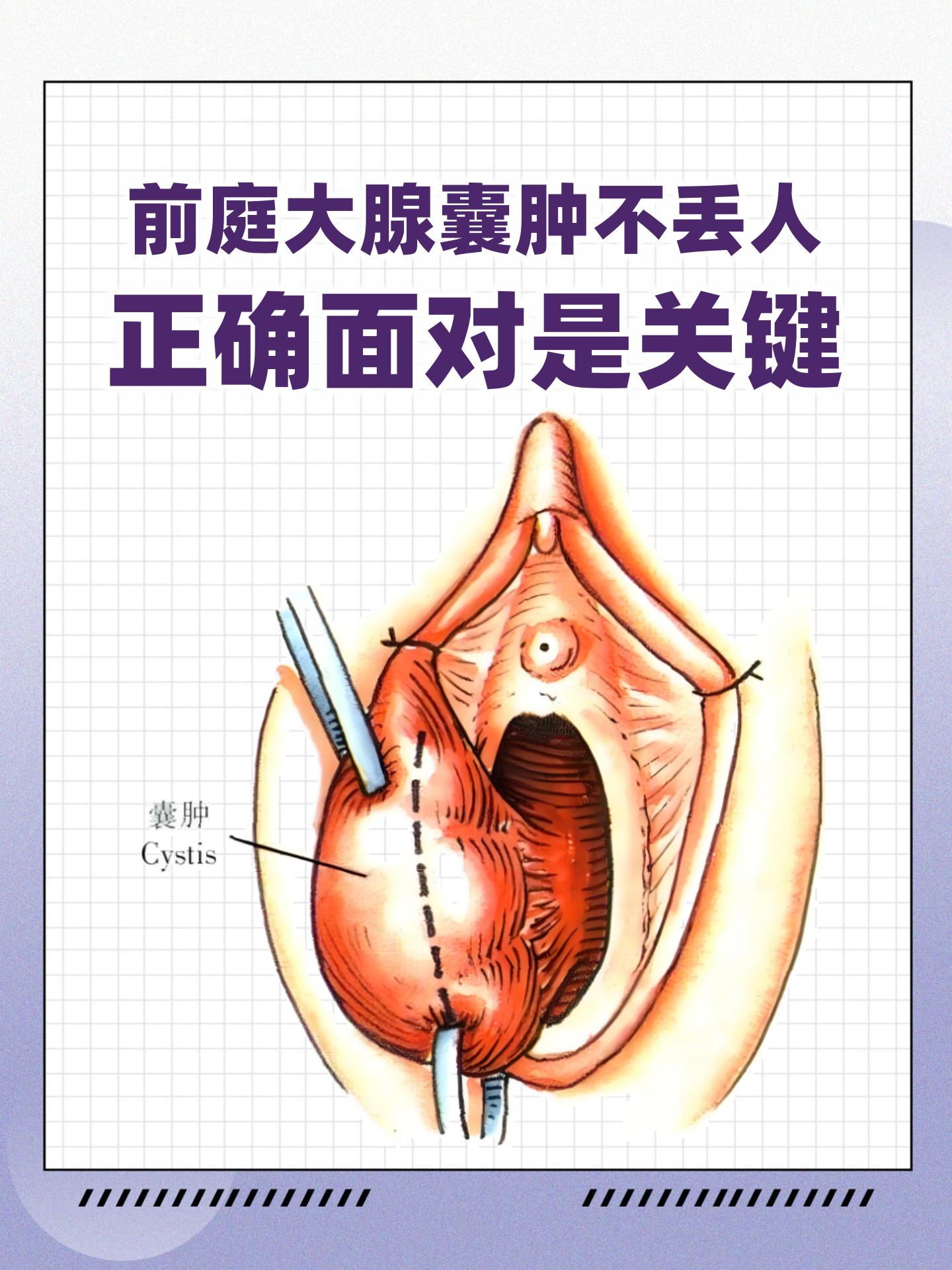 女性前庭腺肿大图片图片