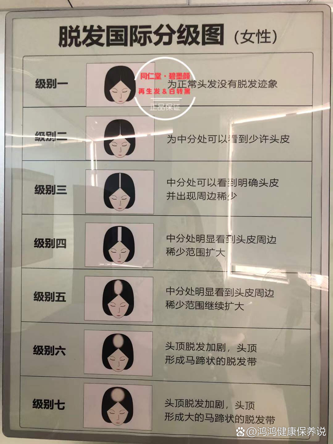 脱发等级 真人对照图图片