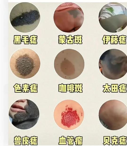 胎记类型对照表