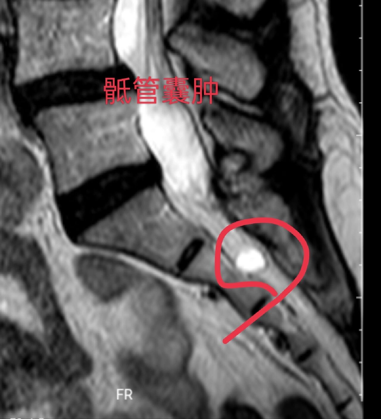 骶管囊肿位置示意图图片