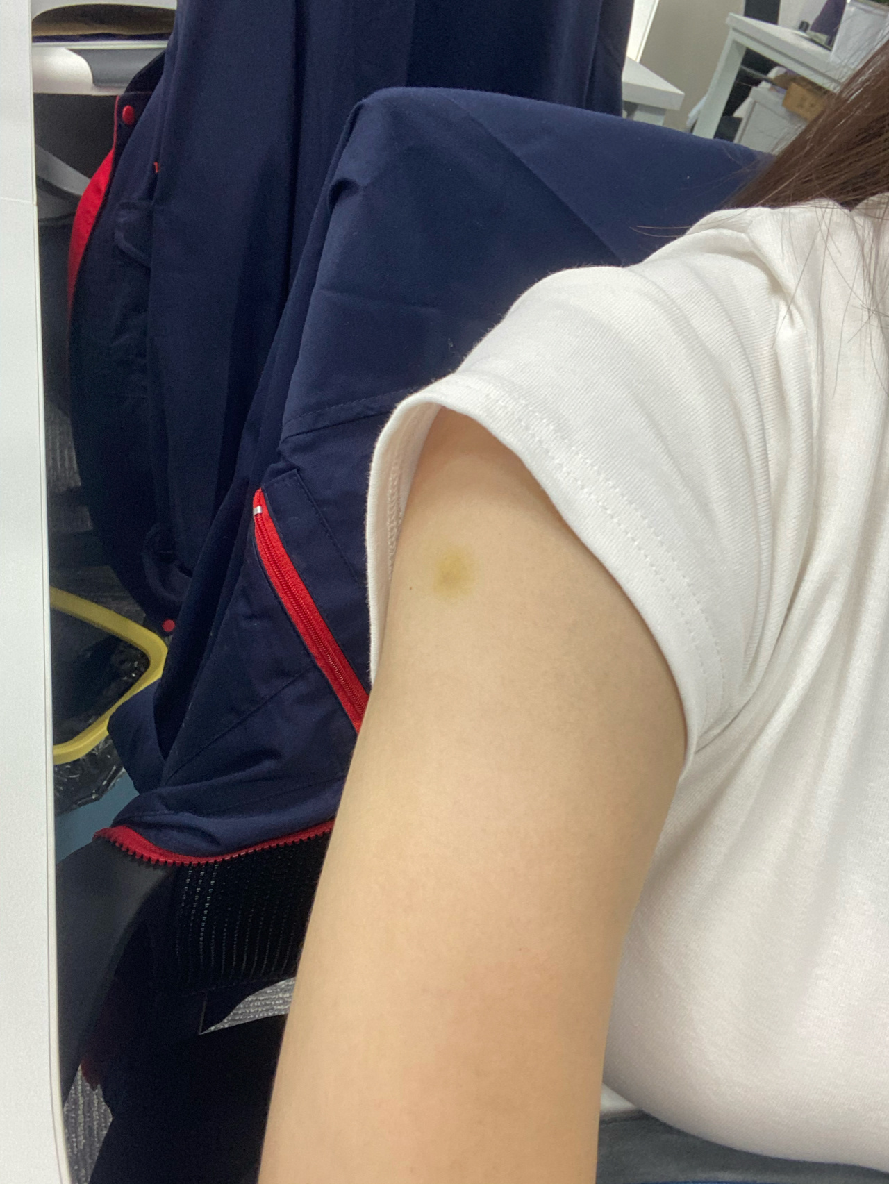 打hpv后手臂肿痛并且淤青