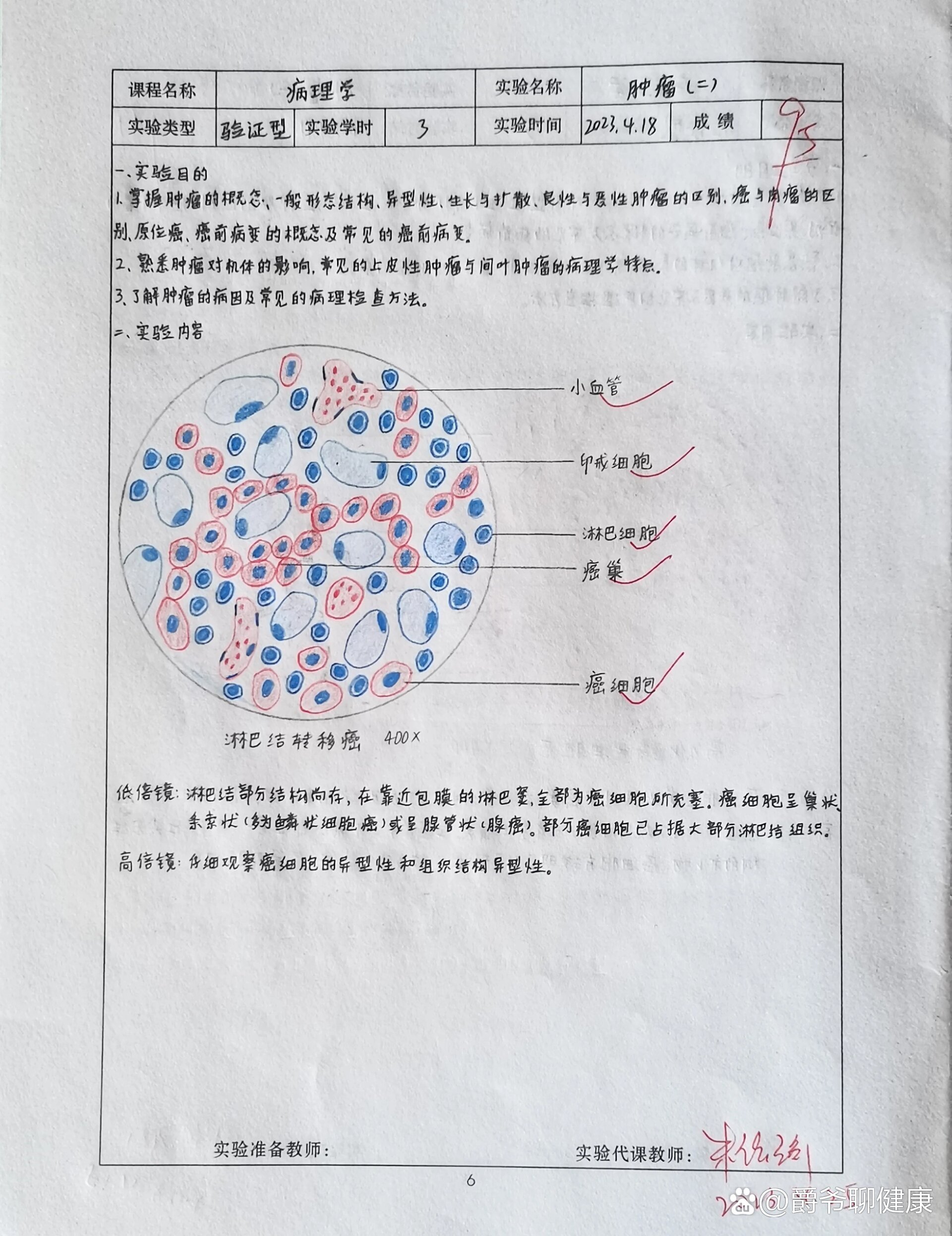 淋巴结转移癌