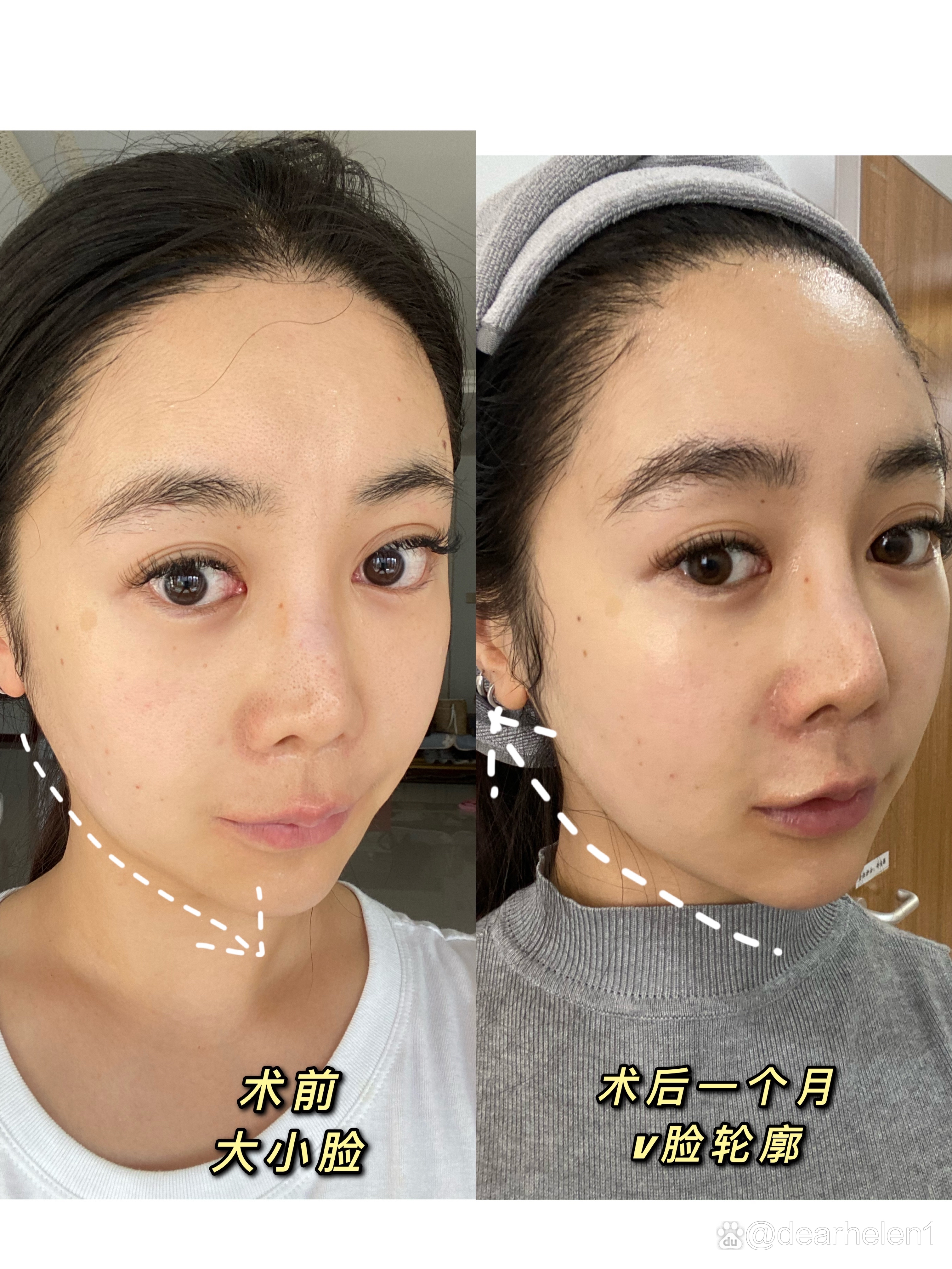 瘦脸针多少钱打一针维持多久?