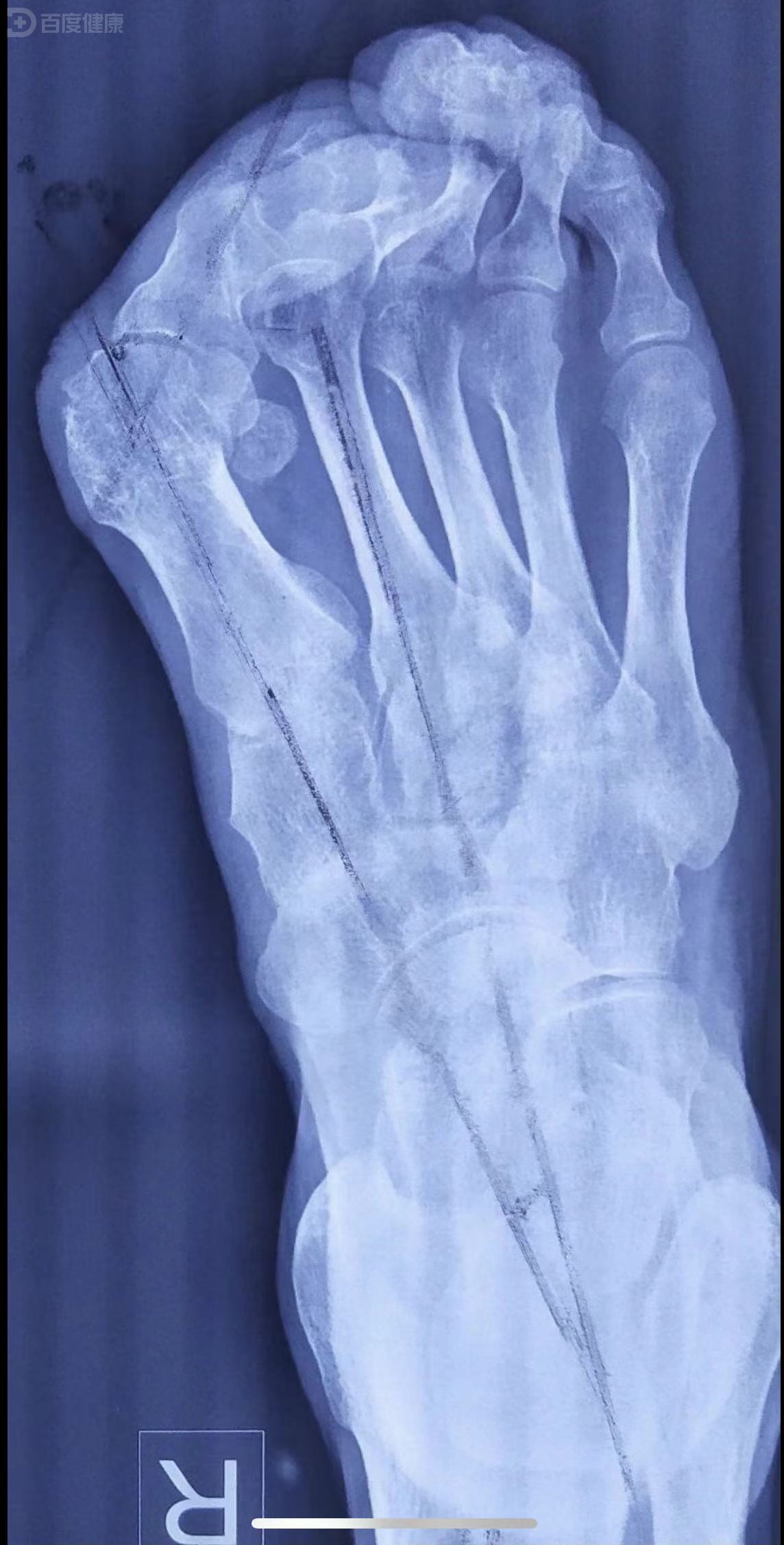 疼痛的大脚骨,一位重度拇外翻患者的治疗过程