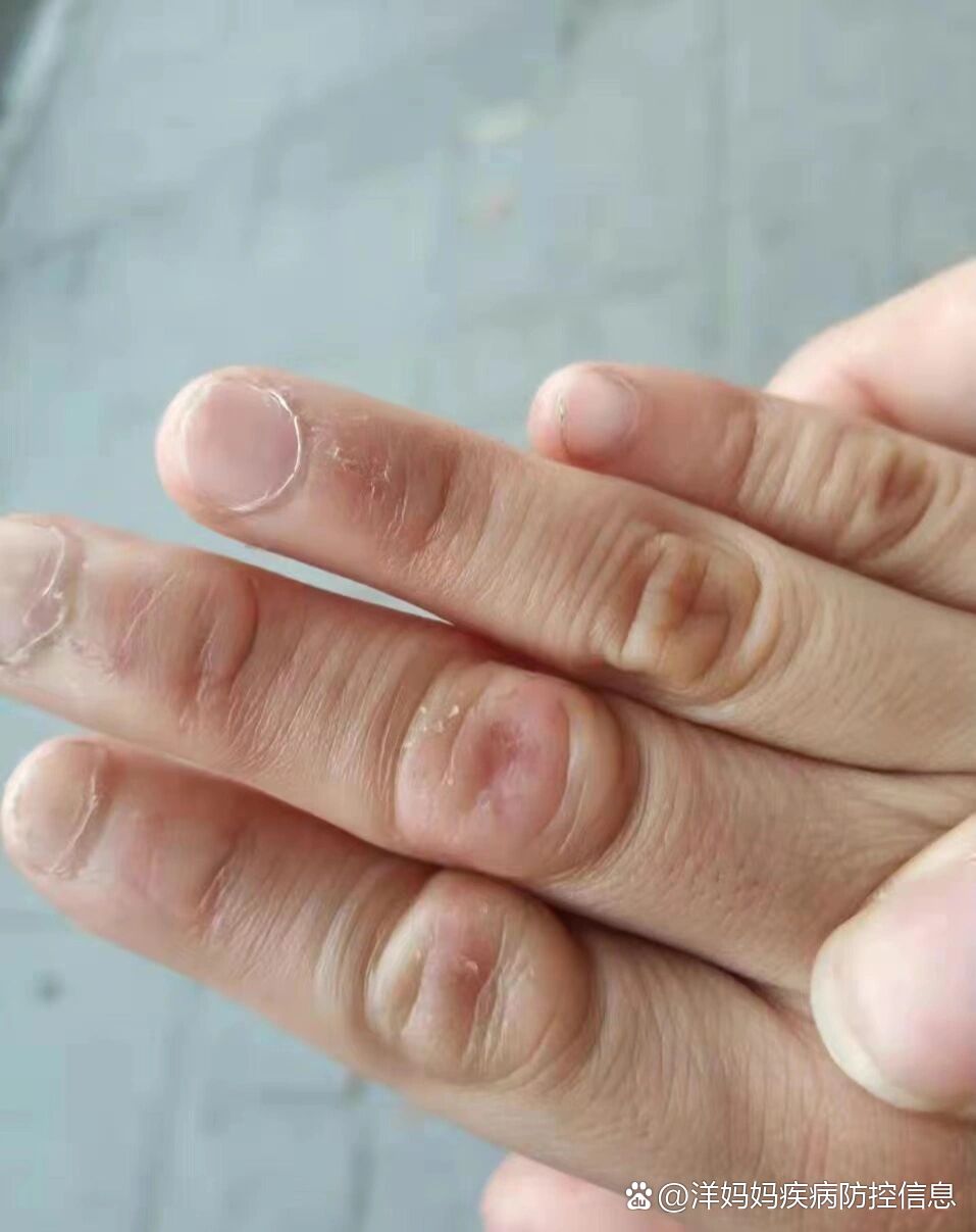 手指背"粗大隆起"