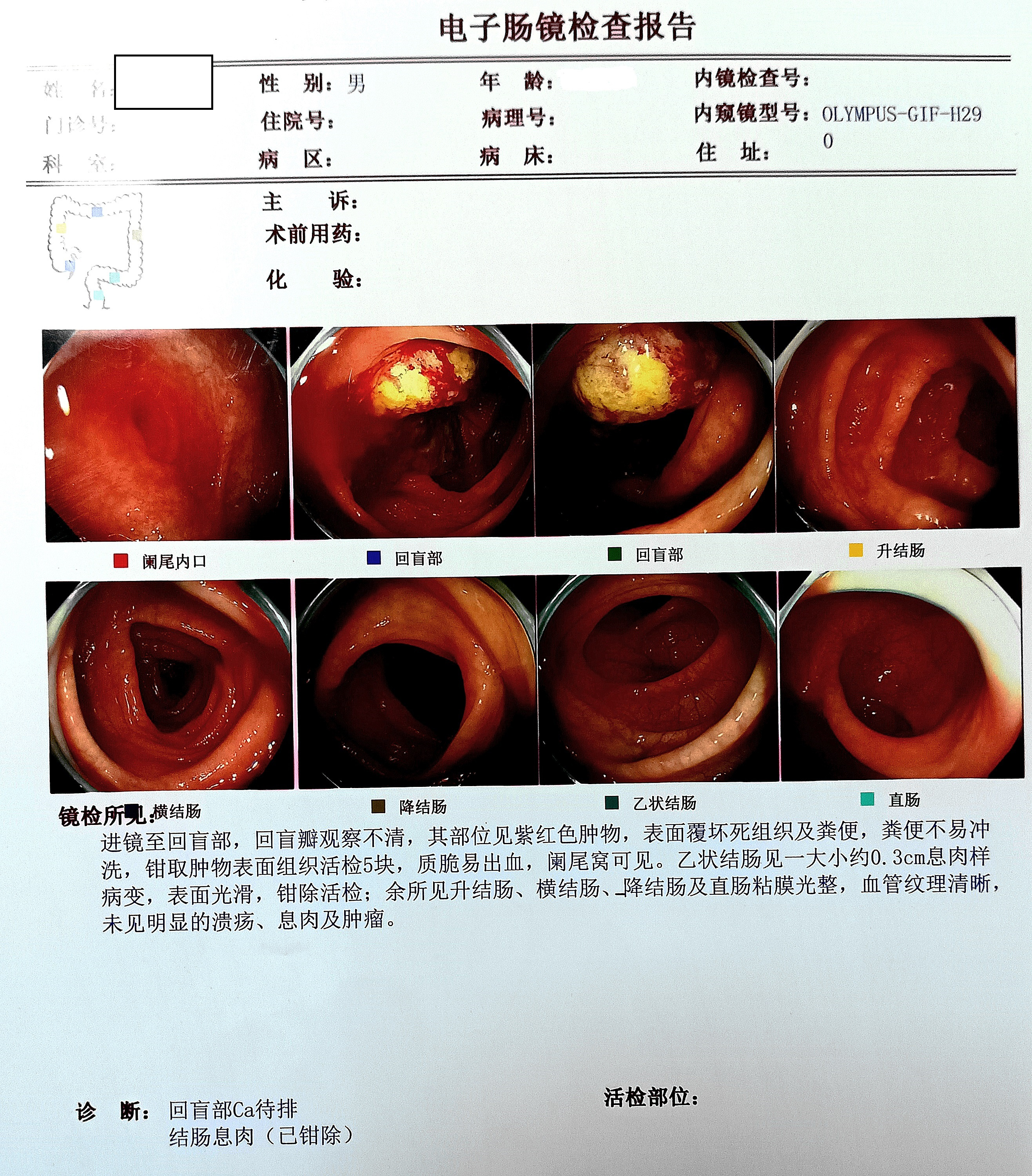 降结肠肿瘤图片