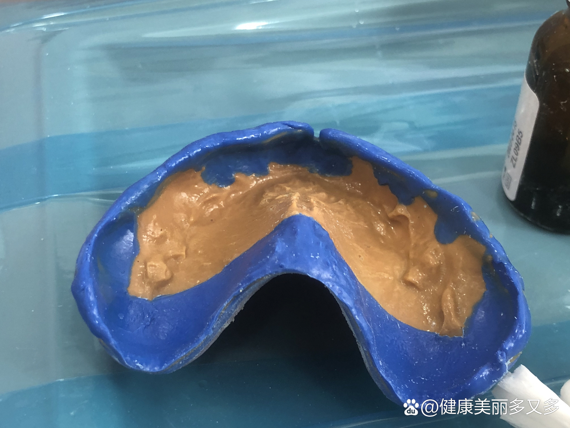  p>吸附性义齿 br>病例 55岁全口上下无牙颌,不能正常进食,先来就诊.