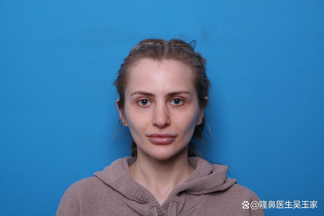 25岁俄罗斯美女,嫁到中国,瞒着老公来京做鼻修复,术后太精致了