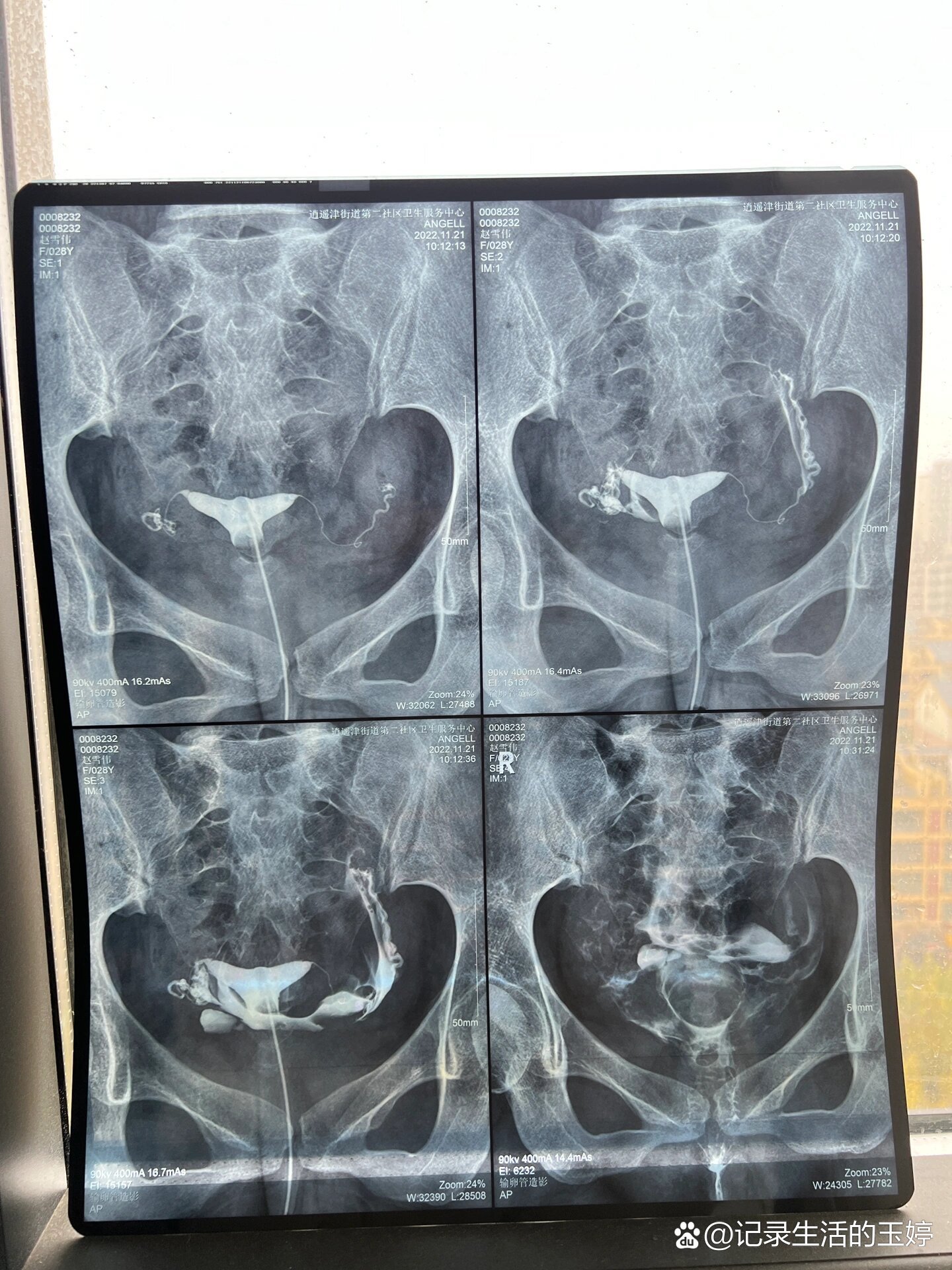 输卵管造影做完啦