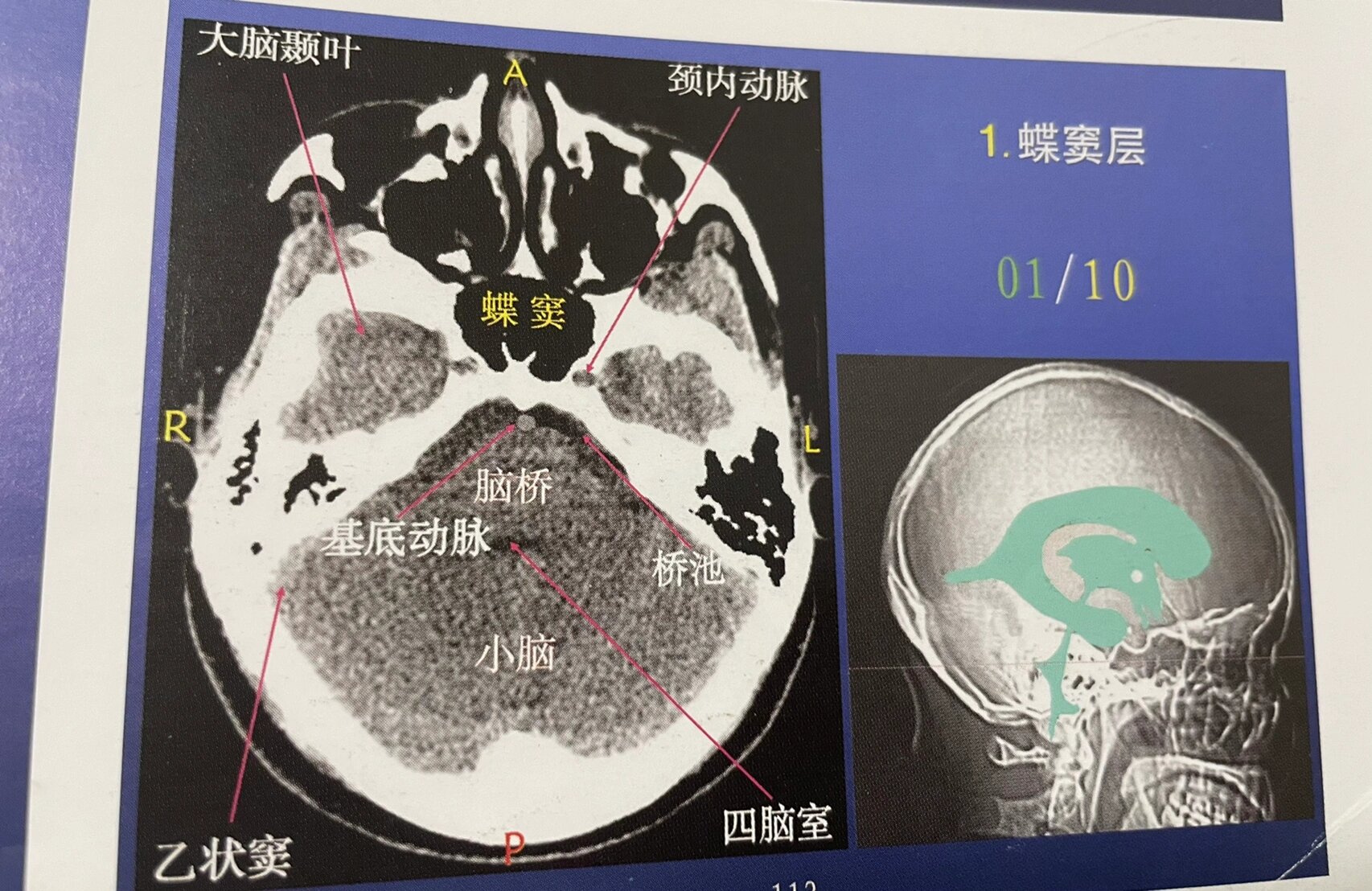 颅内血管CT解剖图图片