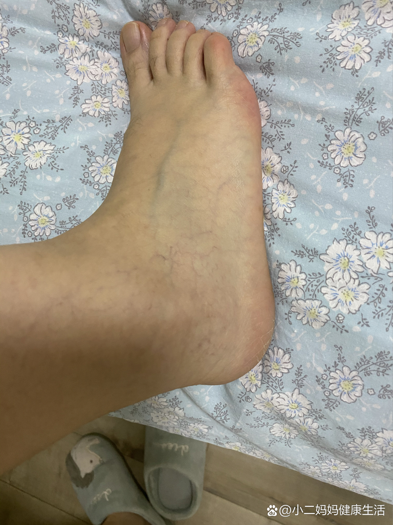 腿肿的莫名其妙1～横纹肌溶解症