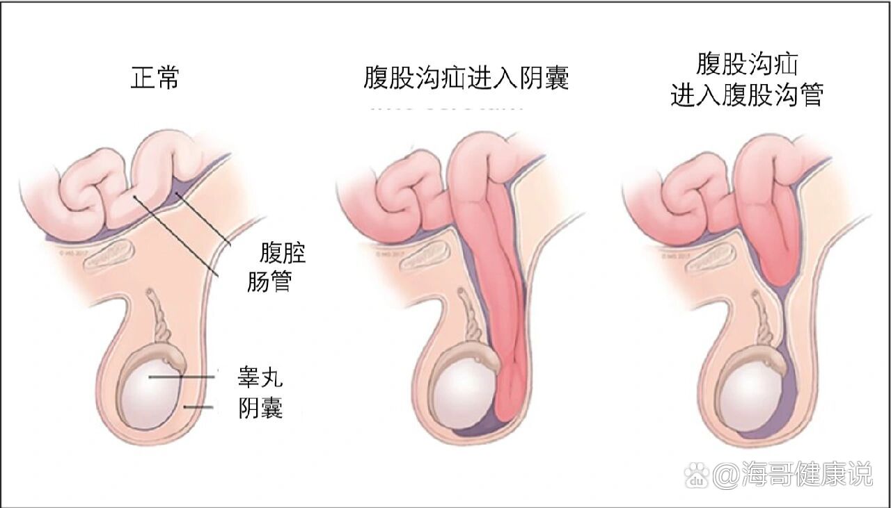 根据您提供的宝宝症状信息提示腹股沟斜疝可能性大,小儿腹股沟斜疝多