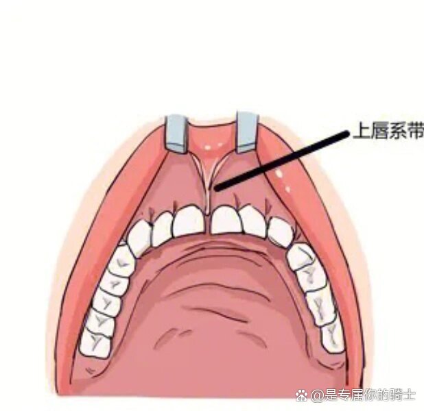 上唇系带断了一半,可咋办办01