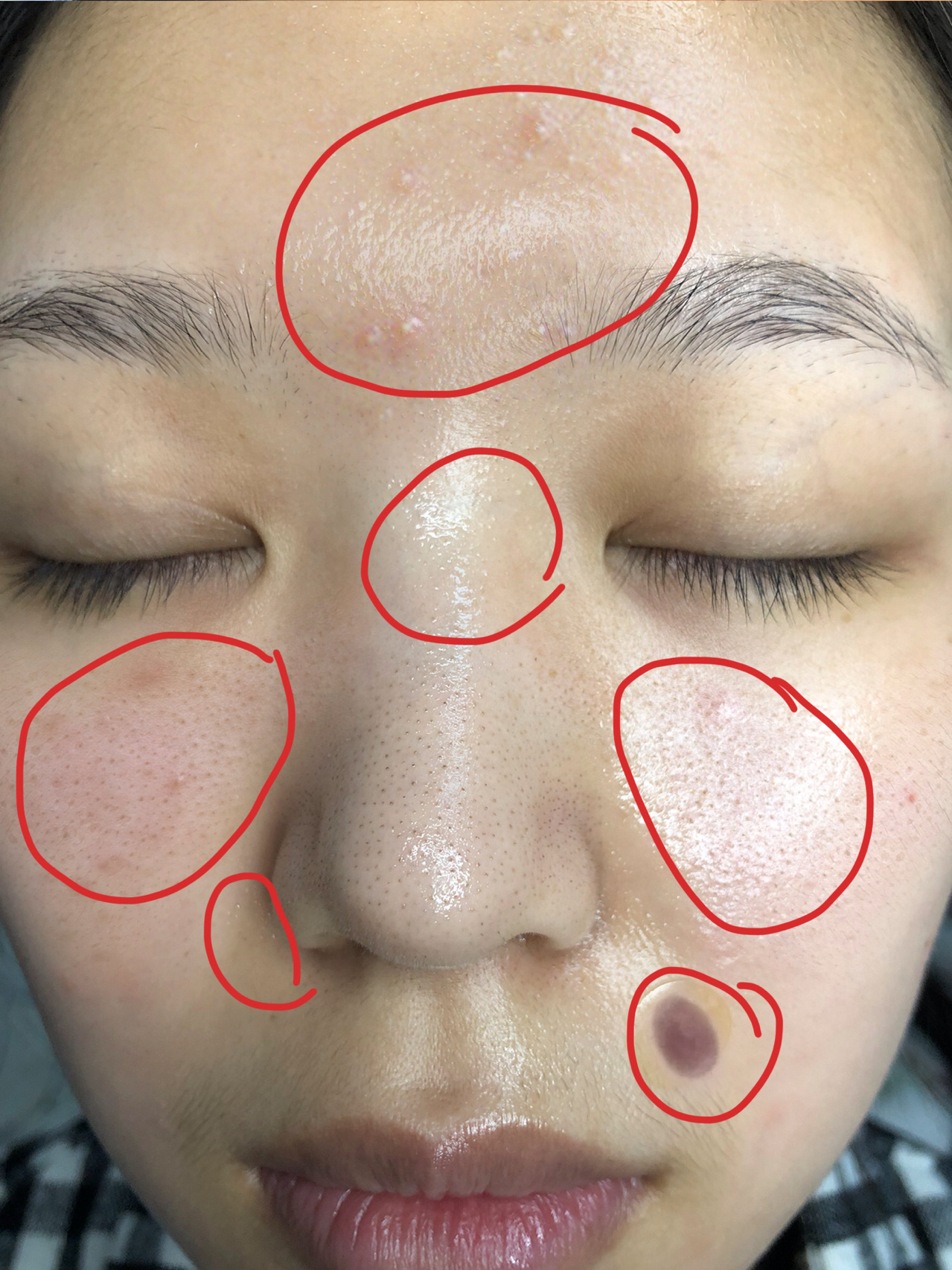 是啥不痒不痛,不怼镜看吧也不咋明显,但是一摸脸上就是凹凸不平的