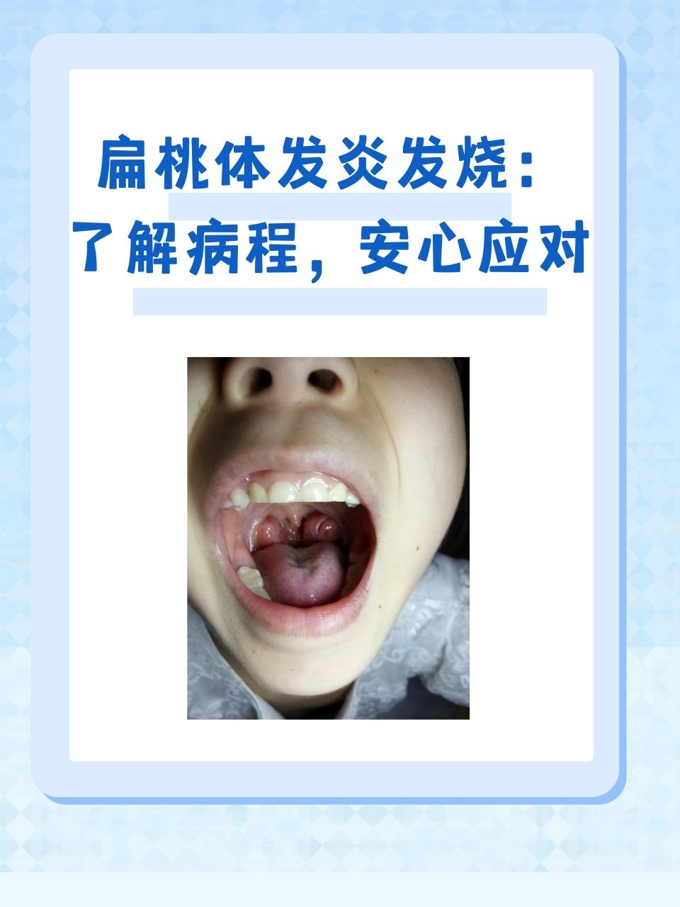扁桃体发炎发烧:了解病程,安心应对