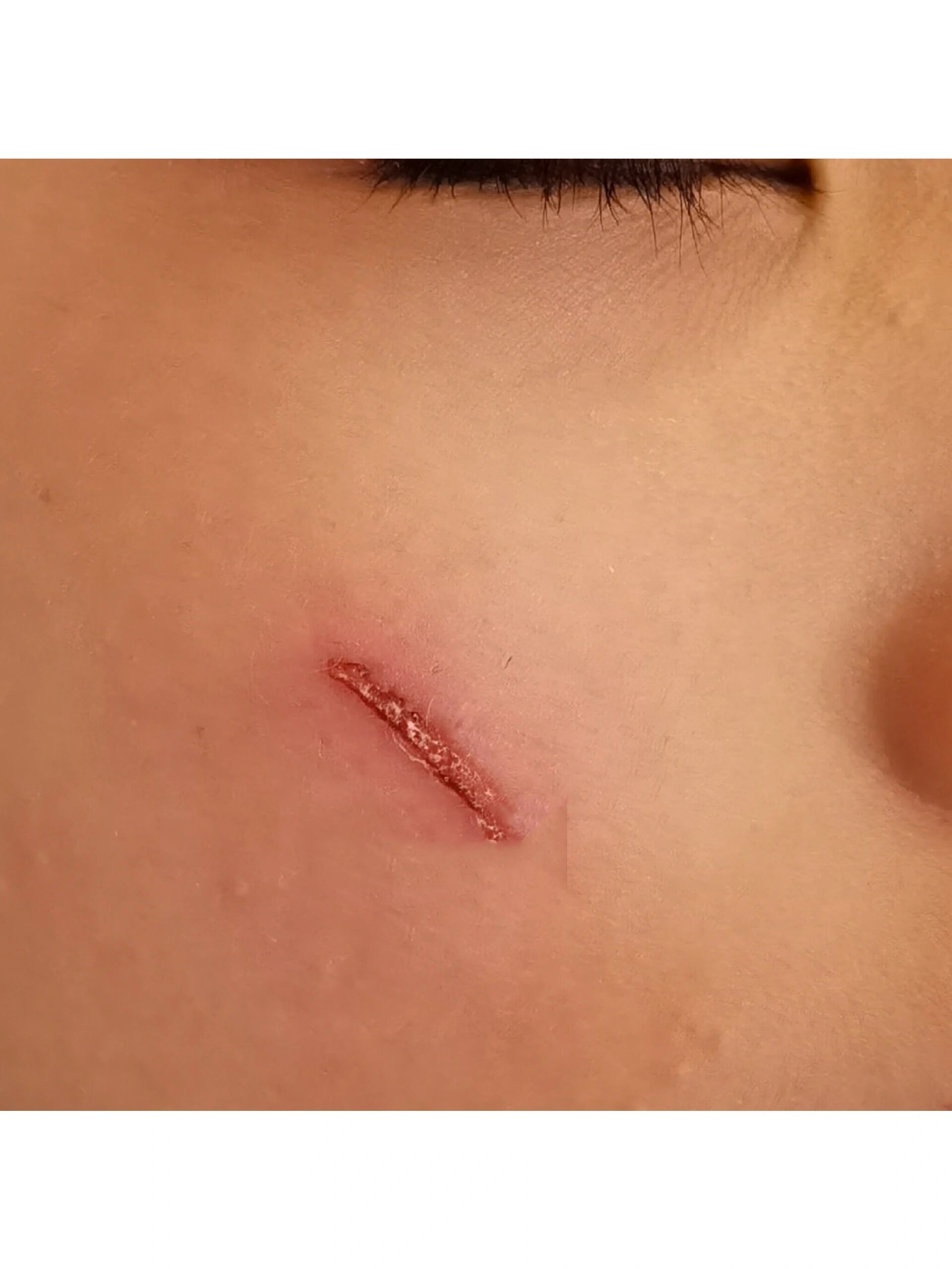 皮肤抓伤day4,生长因子使用第3天!