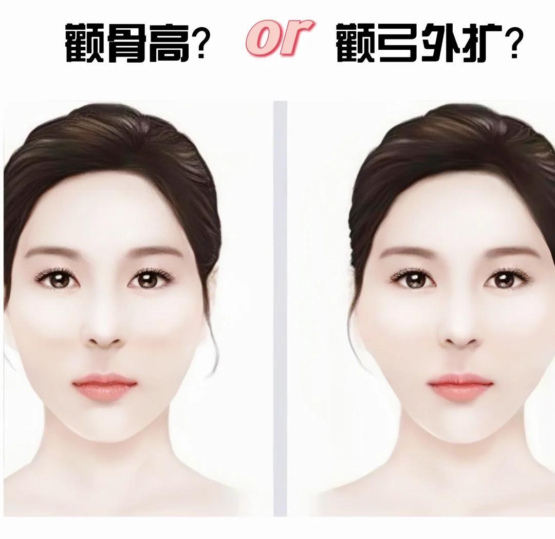 颧骨高与颧弓外扩的区别