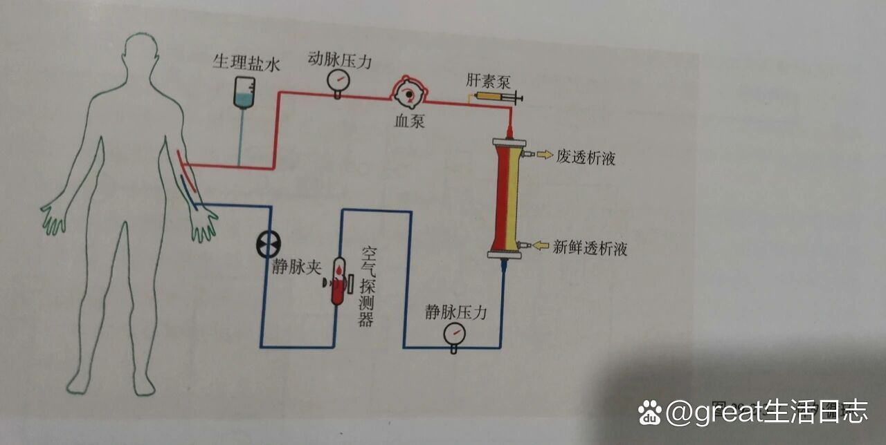 透析那点事儿之原理