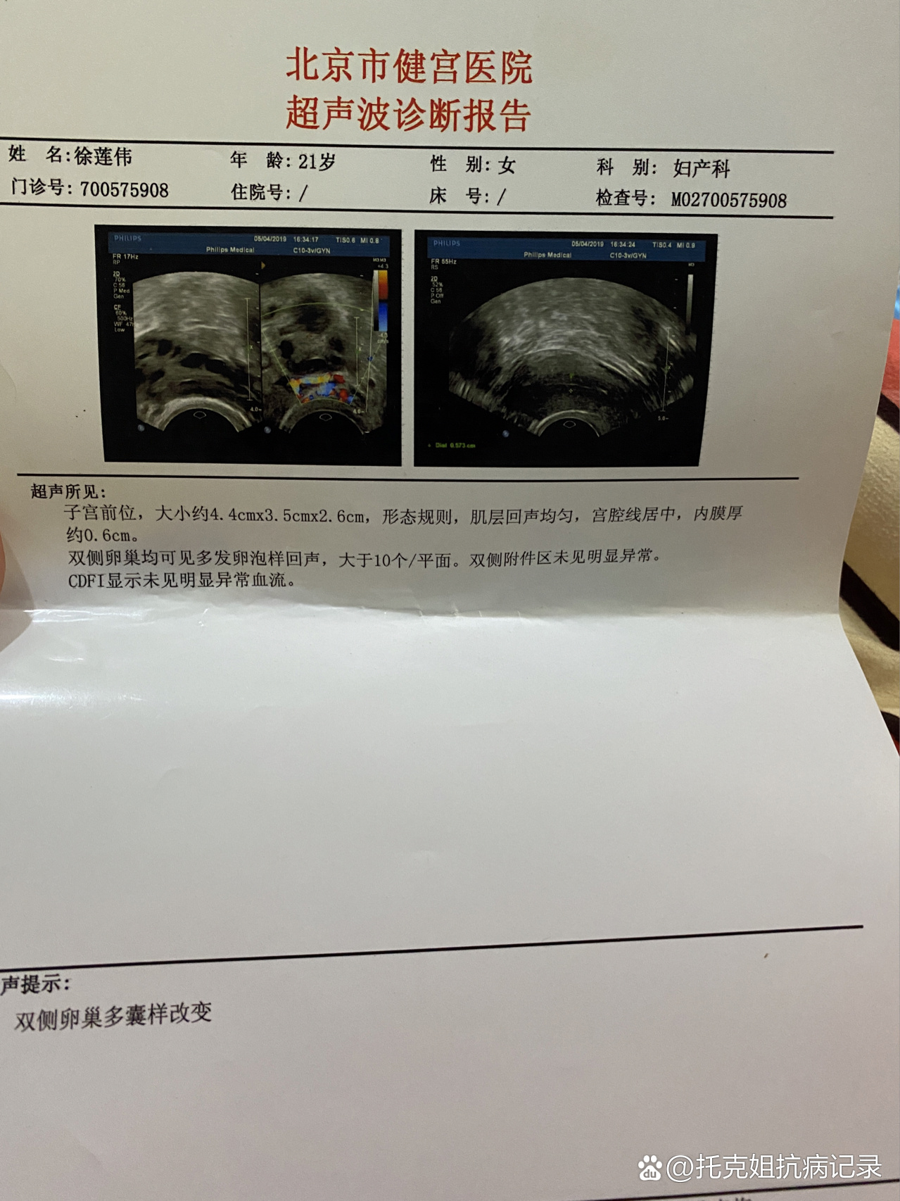 双侧卵巢多囊图片