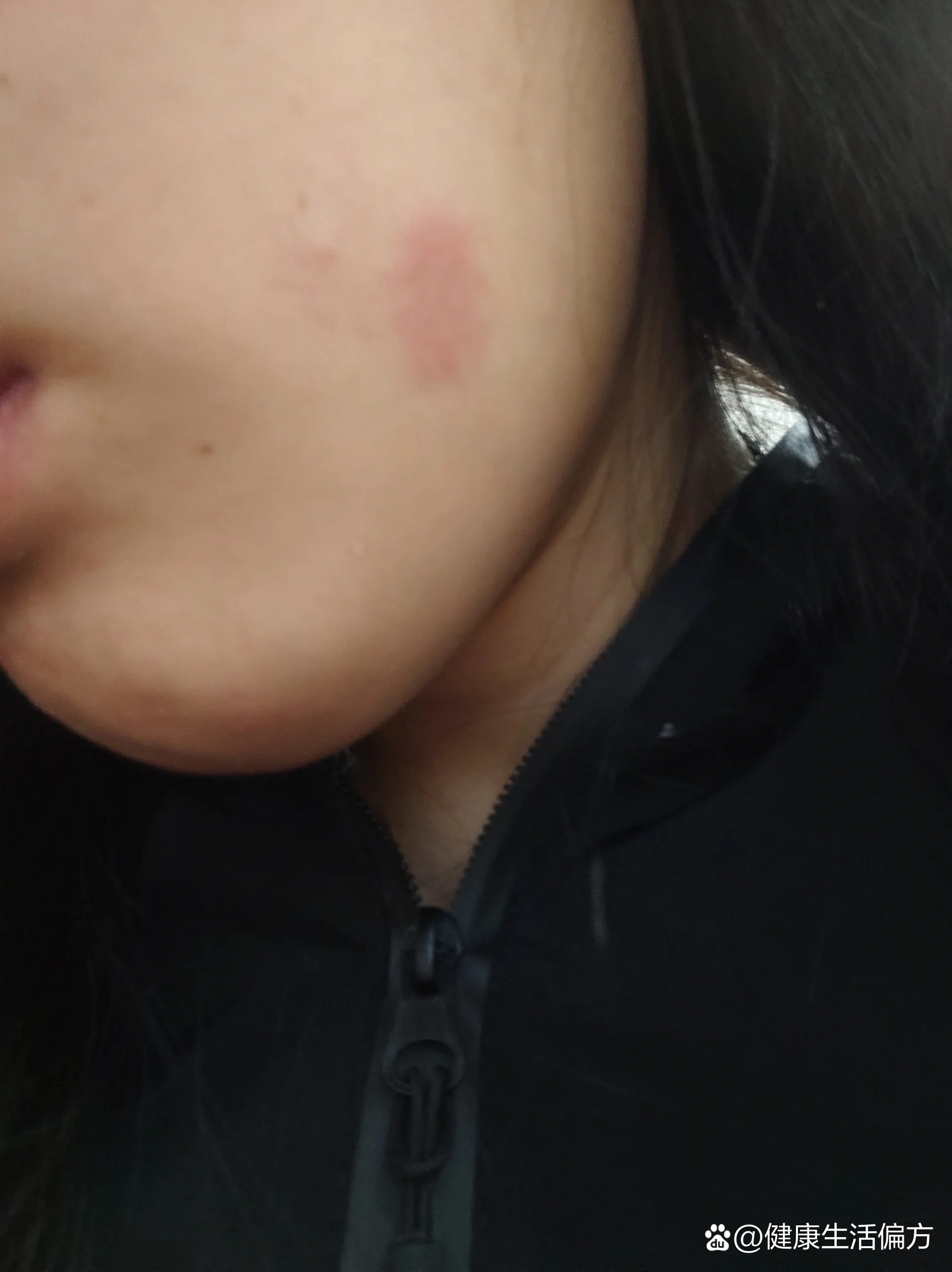 一觉睡醒脸上有个红块