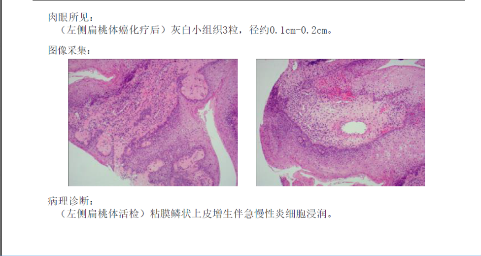 扁桃体鳞状细胞癌导致颈部肿物,采用化疗治疗缓解病痛