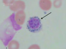 头晕乏力,食欲不佳确诊难治性贫血伴环状铁粒幼红细胞?