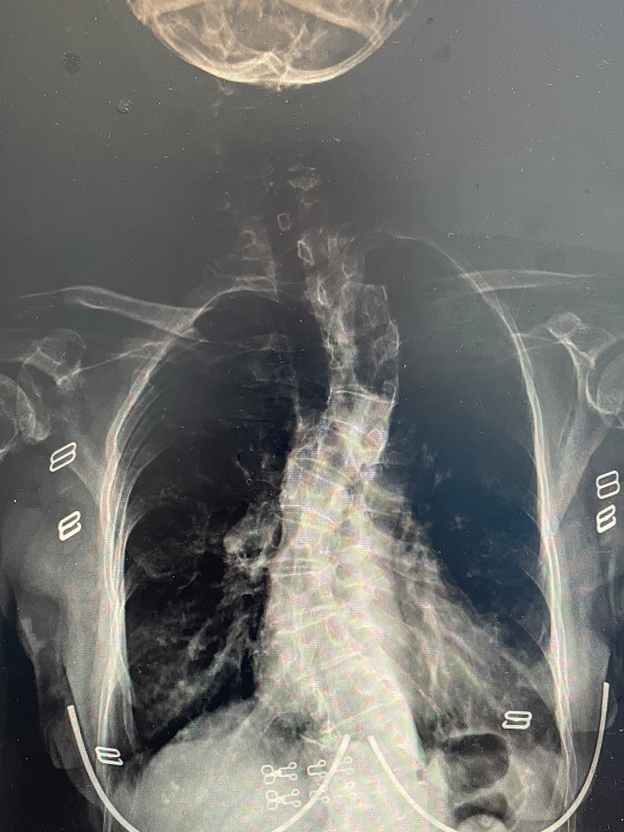 脊柱侧弯多年不治疗,只会加重背部畸形程度!