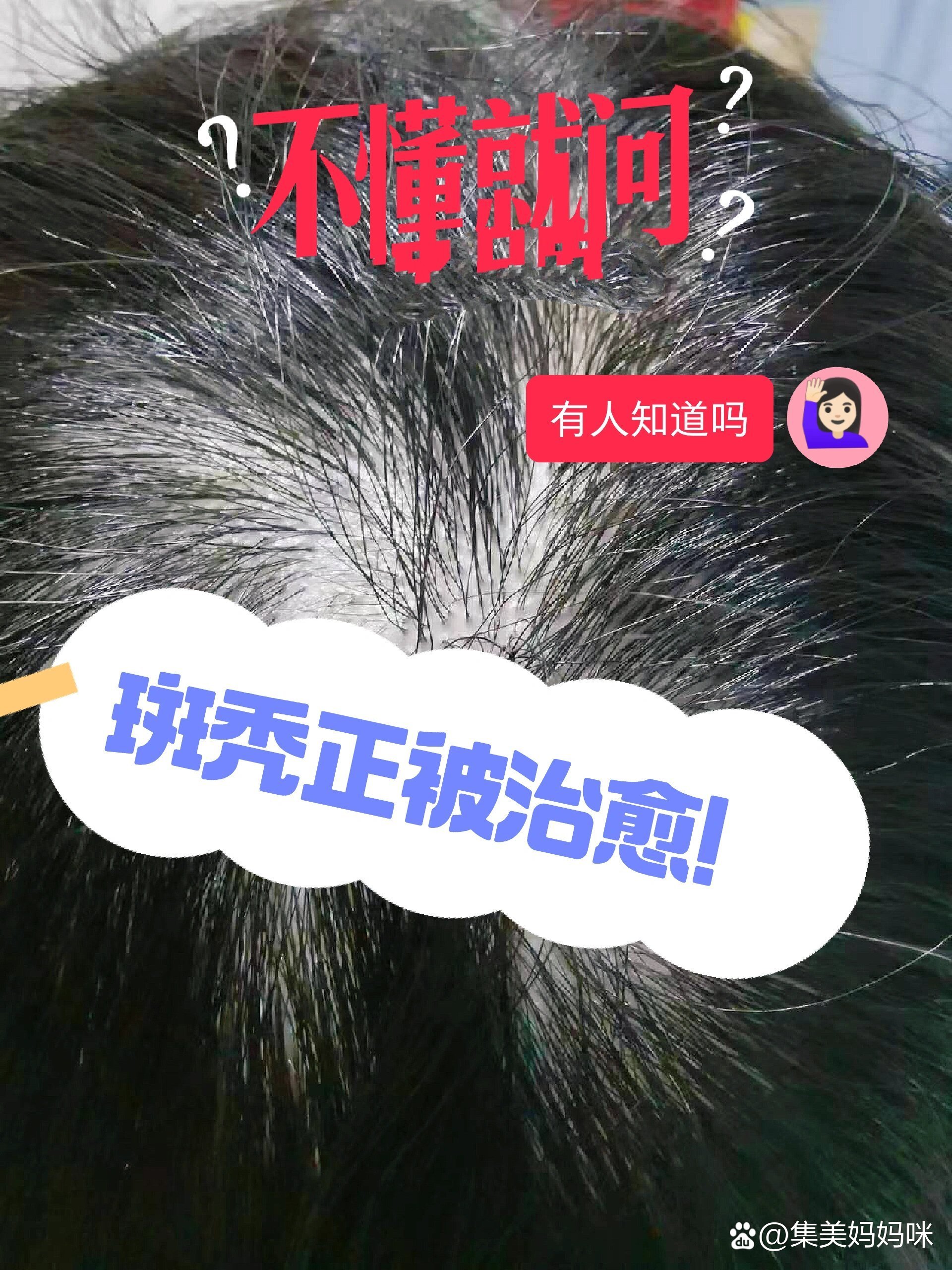 5岁幼童斑秃正被治愈