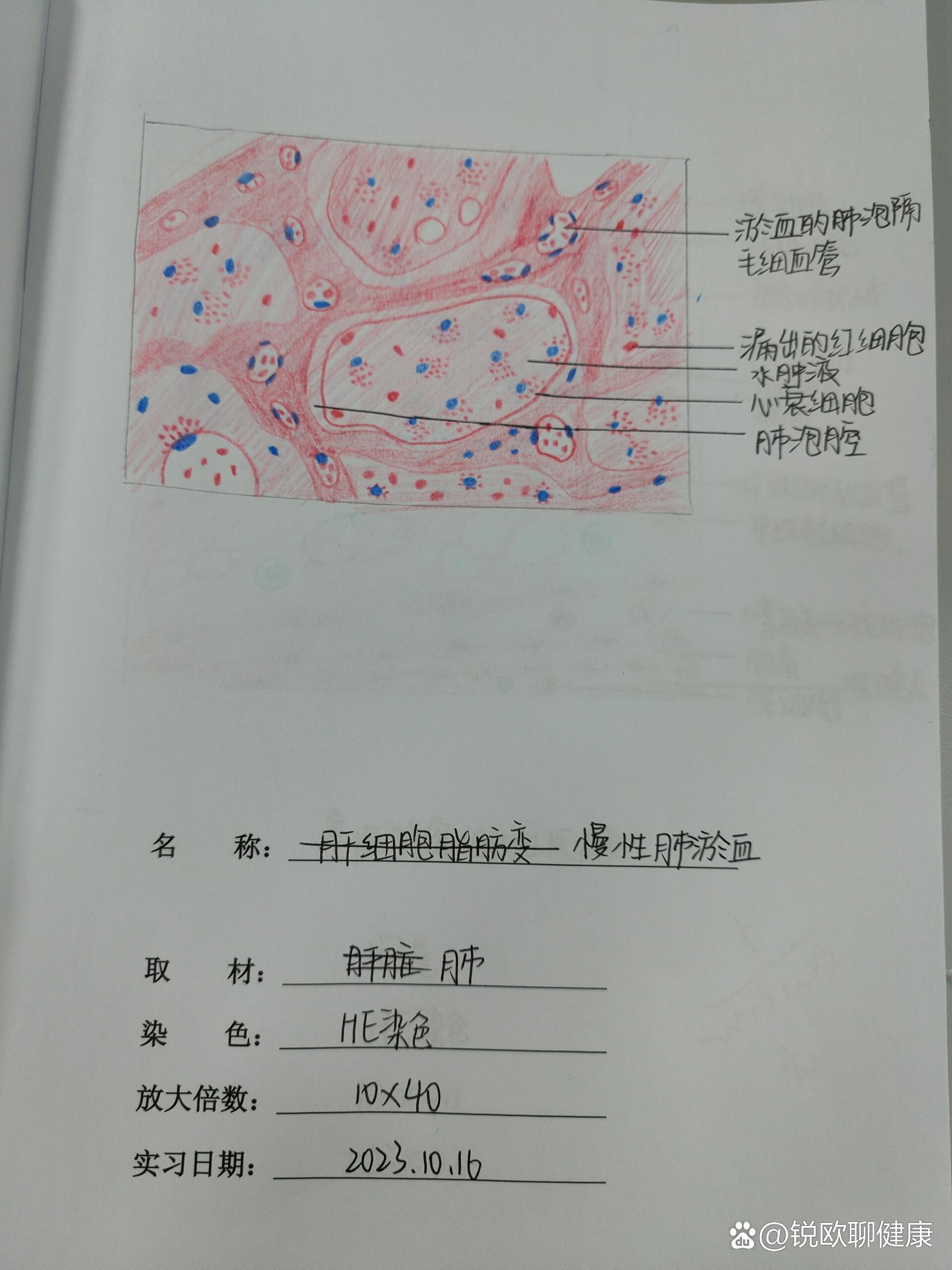 慢性肺淤血的镜下特点图片