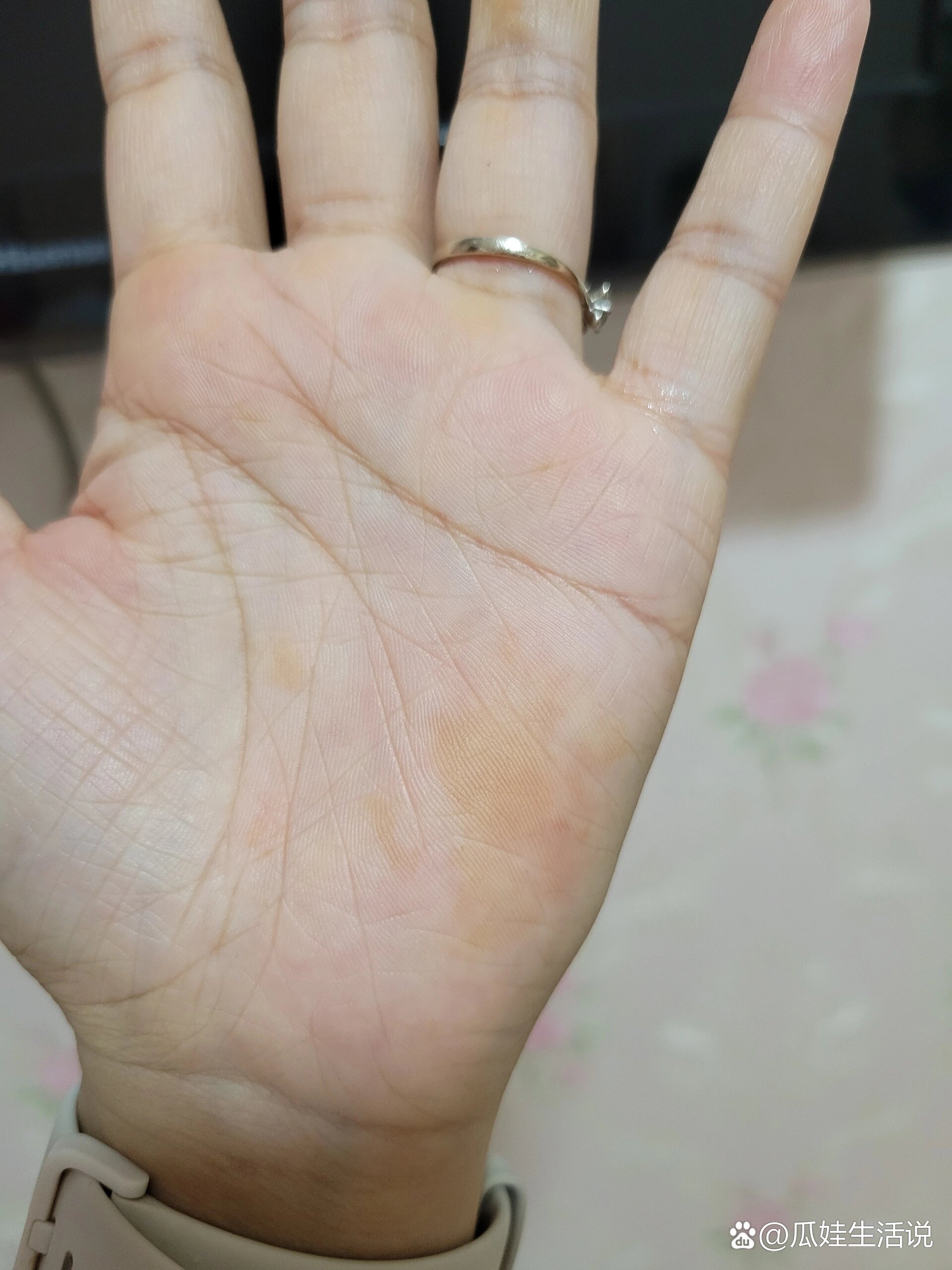 手掌黄斑