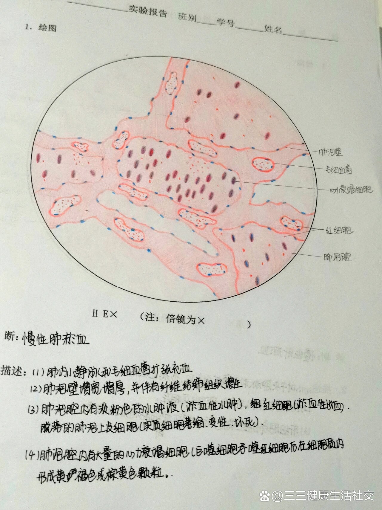 肺淤血的镜下结构图片图片