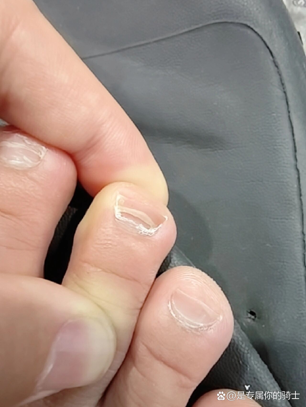 指甲断层 分层怎么回事呀?