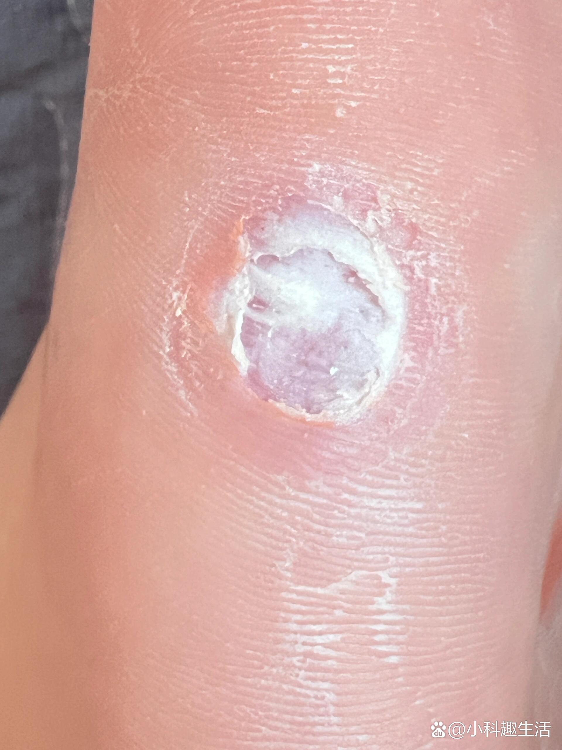  p>鸡眼问题🙋 br>这是算好了吗鸡眼?我把白色腐肉刮没了.