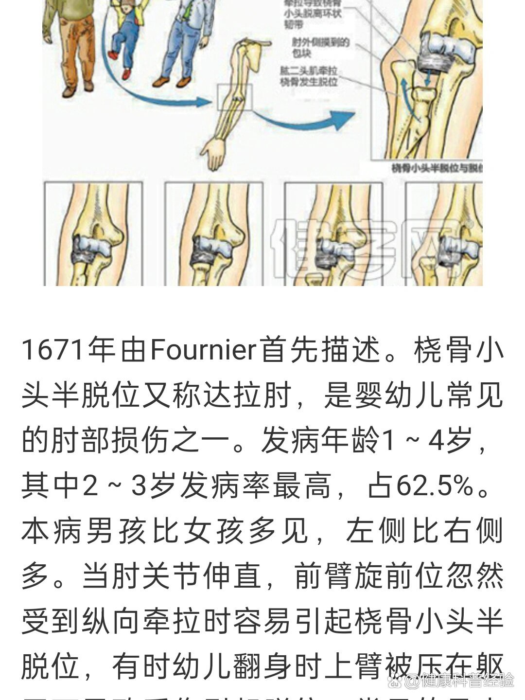 桡骨小头半脱位科普