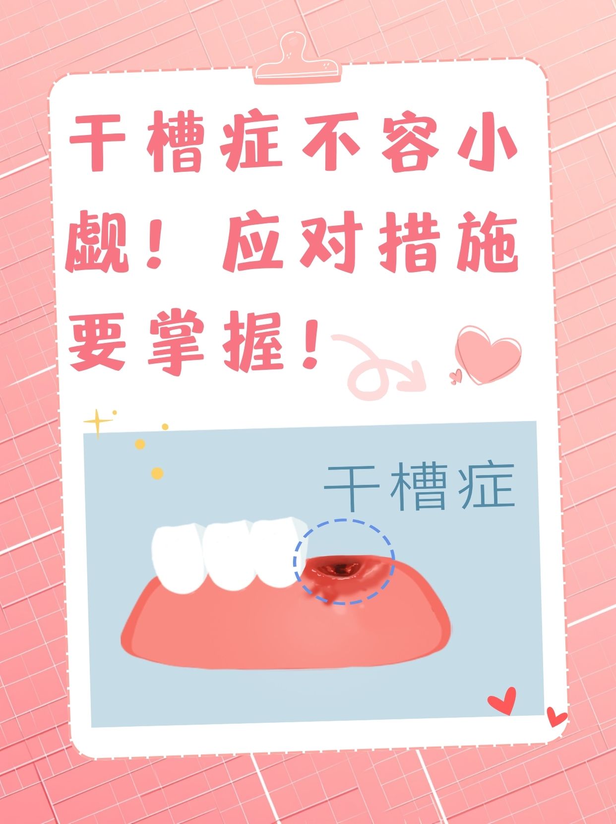 干槽症?拔牙后的隐形杀手!