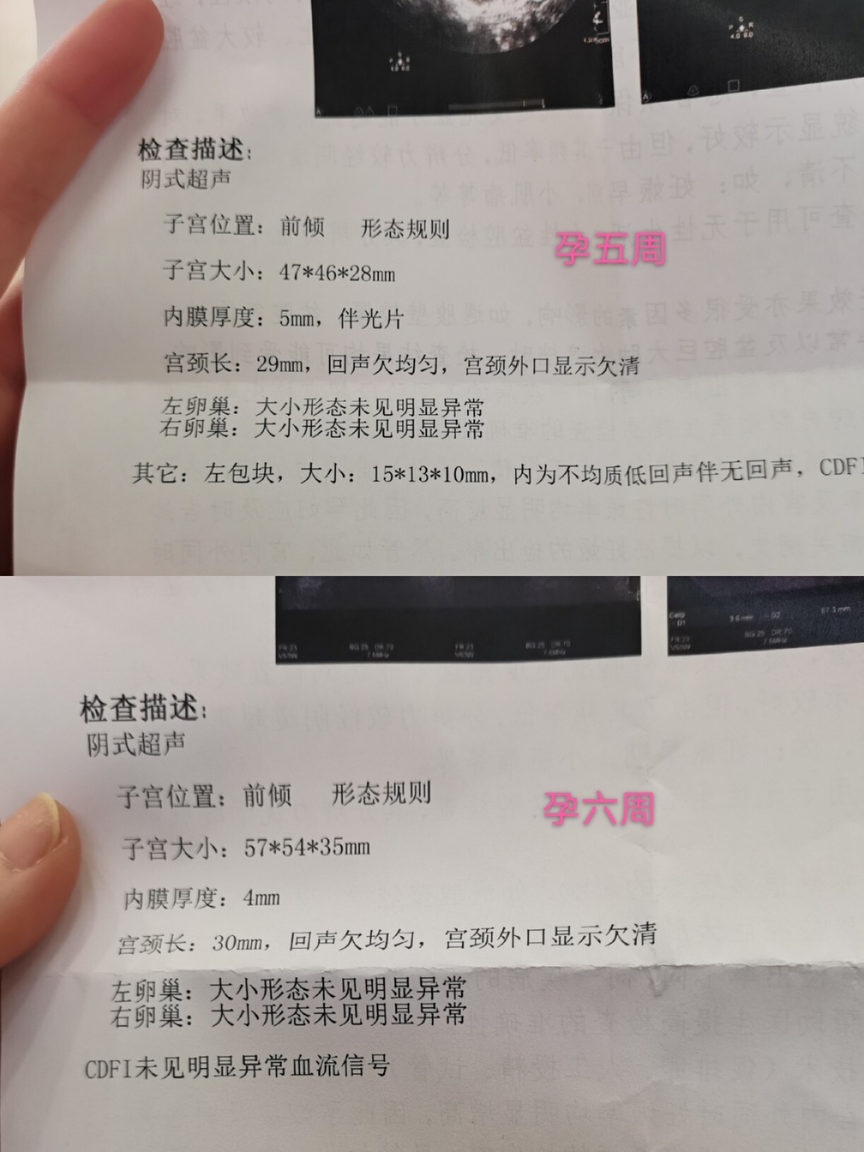 宫外孕生化了