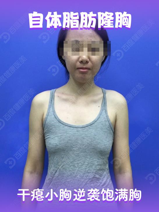 干瘪下垂胸的改善