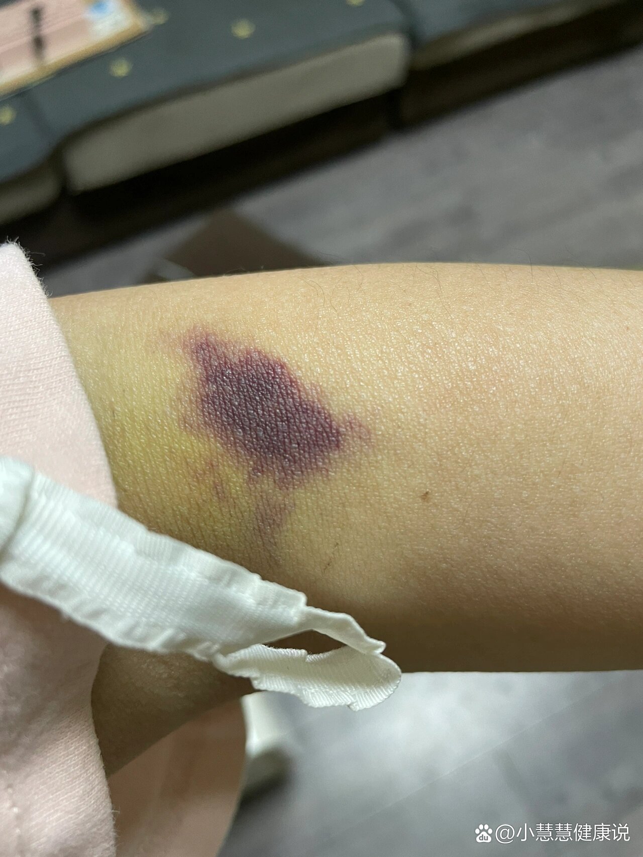 体检抽血,完了胳膊又紫了