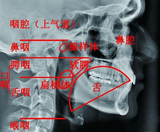 49.怎么通过拍片确定腺样体肥大?