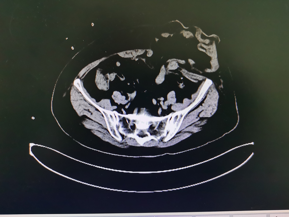 肠造口周围隆起明显,不容忽视的造口旁疝